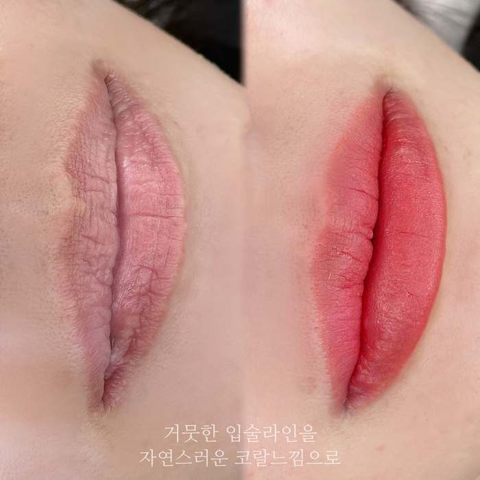 입술문신, 거뭇한 입술라인을 자연스러운 코랄느낌으로